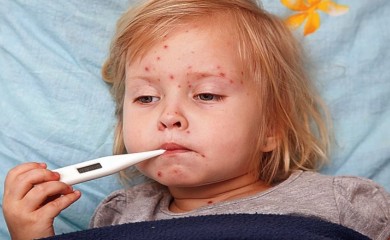 U Srbiji potvrđeni prvi slučajevi malih boginja