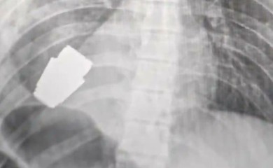 Hirurzi iz grudi ukrajinskog vojnika uklonili neeksplodiranu granatu