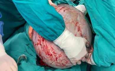 Detalji operacije u Banjaluci: Tumor težak 23 kilograma uklanjali dva i po časa