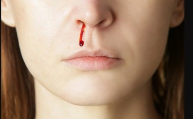 Šta raditi kada krene krv iz nosa?