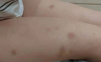 Majka kćerkici gasila cigarete po tijelu