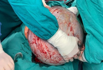 Detalji operacije u Banjaluci: Tumor težak 23 kilograma uklanjali dva i po časa