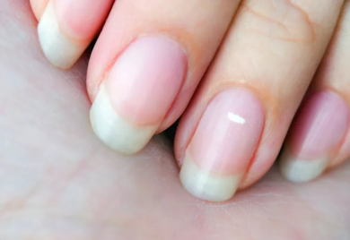 Da li bijele mrlje na noktima ukazuju na zdravstveni problem?