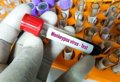Panika zbog majmunskih boginja: Epidemiolog objašnjava koji su simptomi i kako se prenose