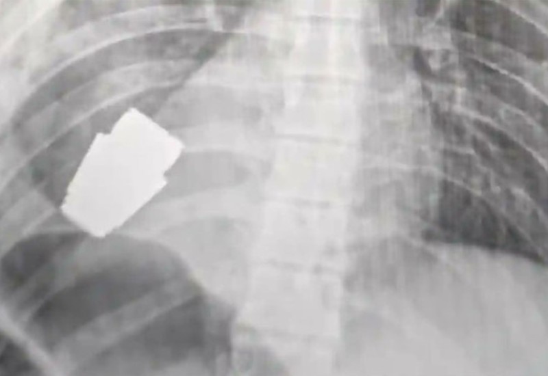 Hirurzi iz grudi ukrajinskog vojnika uklonili neeksplodiranu granatu