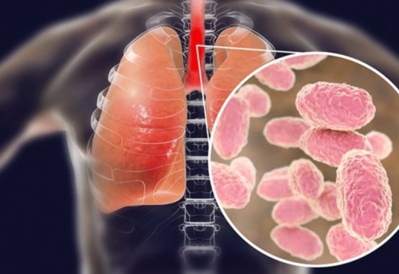 Posljedica izbjegavanja vakcina: Potvrđeno 16 slučajeva velikog kašlja u Srpskoj