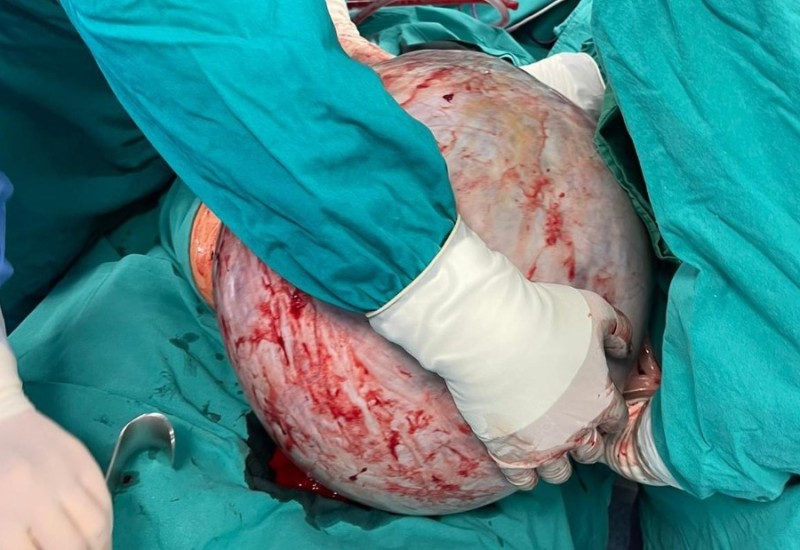 Detalji operacije u Banjaluci: Tumor težak 23 kilograma uklanjali dva i po časa